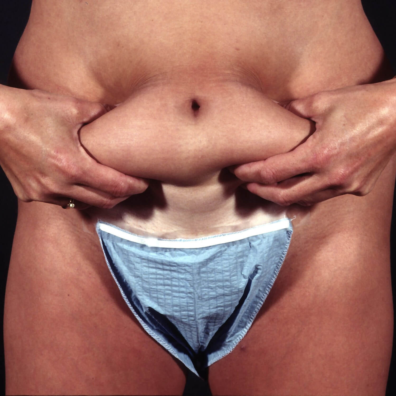 Liposuction--9189 | After Body