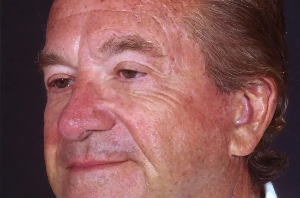 Blepharoplasty--5408 | After Blepharoplasty 4