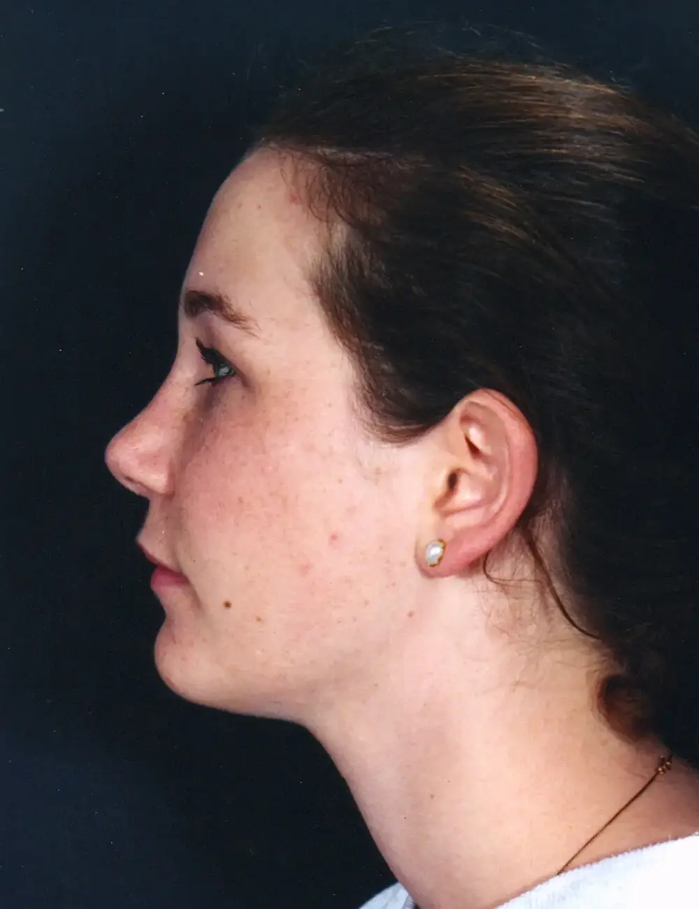 Rhinoplasty #4877 After Profile View