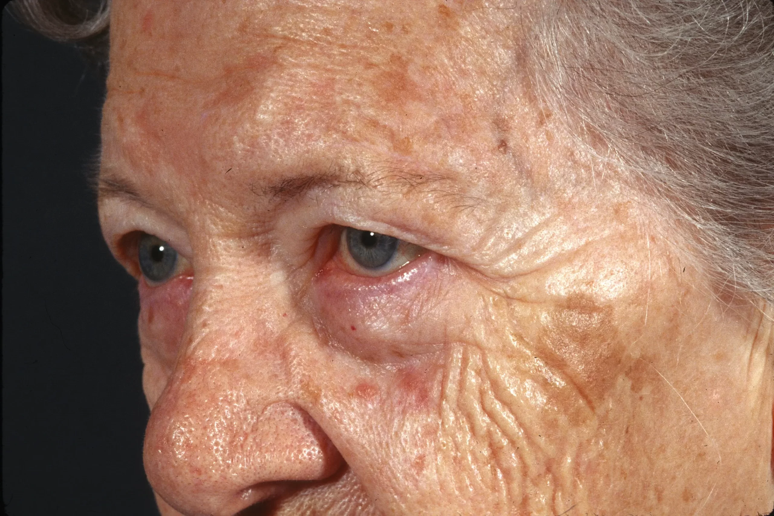 Blepharoplasty--2760 | Before Blepharoplasty 2