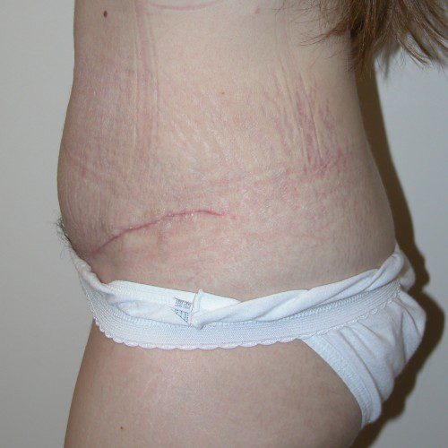 Abdominoplasty--9137 | After Abdominoplasty 2