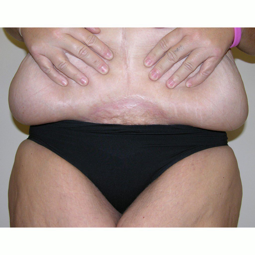 Abdominoplasty--2209 | Before Abdominoplasty 3