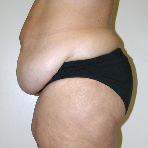 Abdominoplasty--2209 | Before Abdominoplasty 2