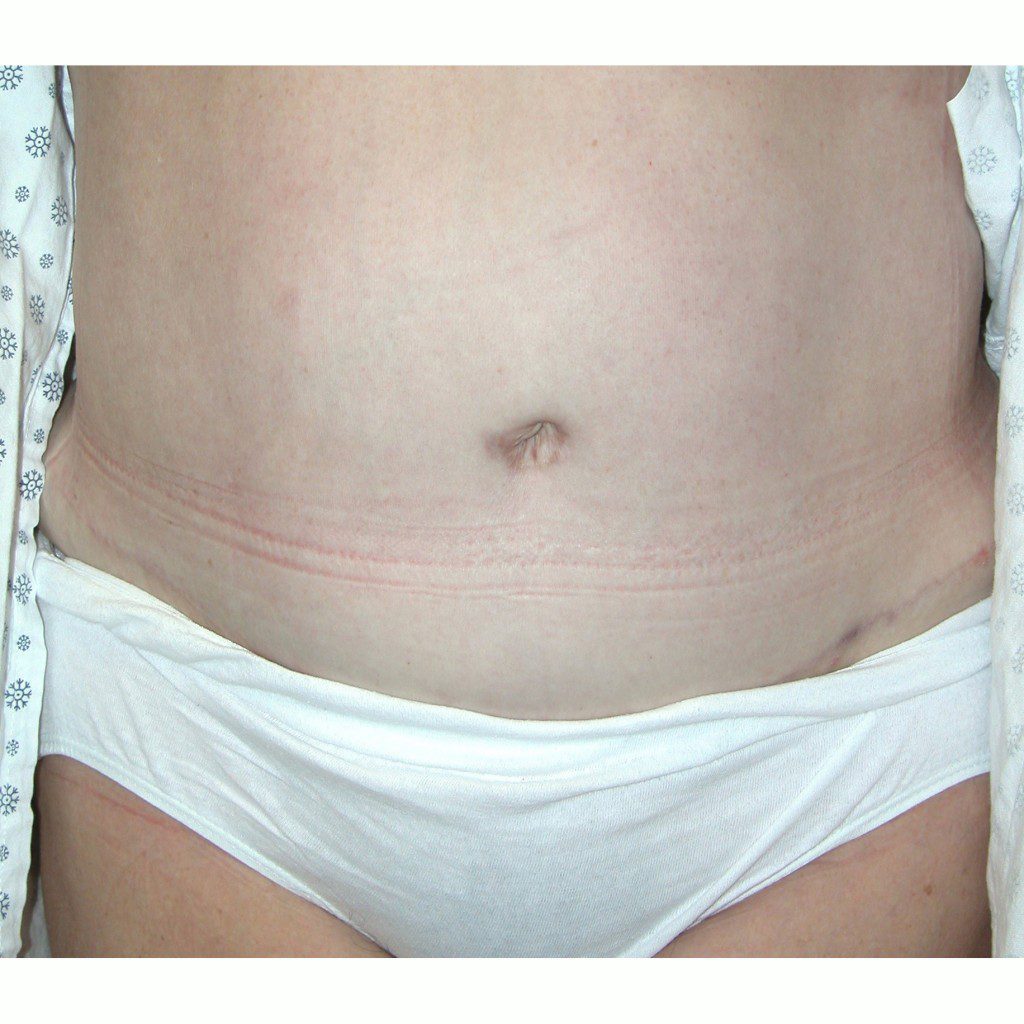 Abdominoplasty--9657 | After Abdominoplasty 1