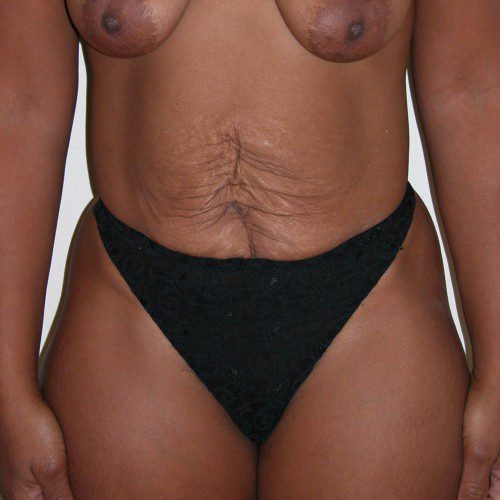 Abdominoplasty--9539 | Before Abdominoplasty