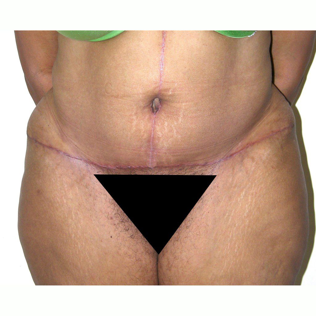 Abdominoplasty--2320 | After Abdominoplasty 1