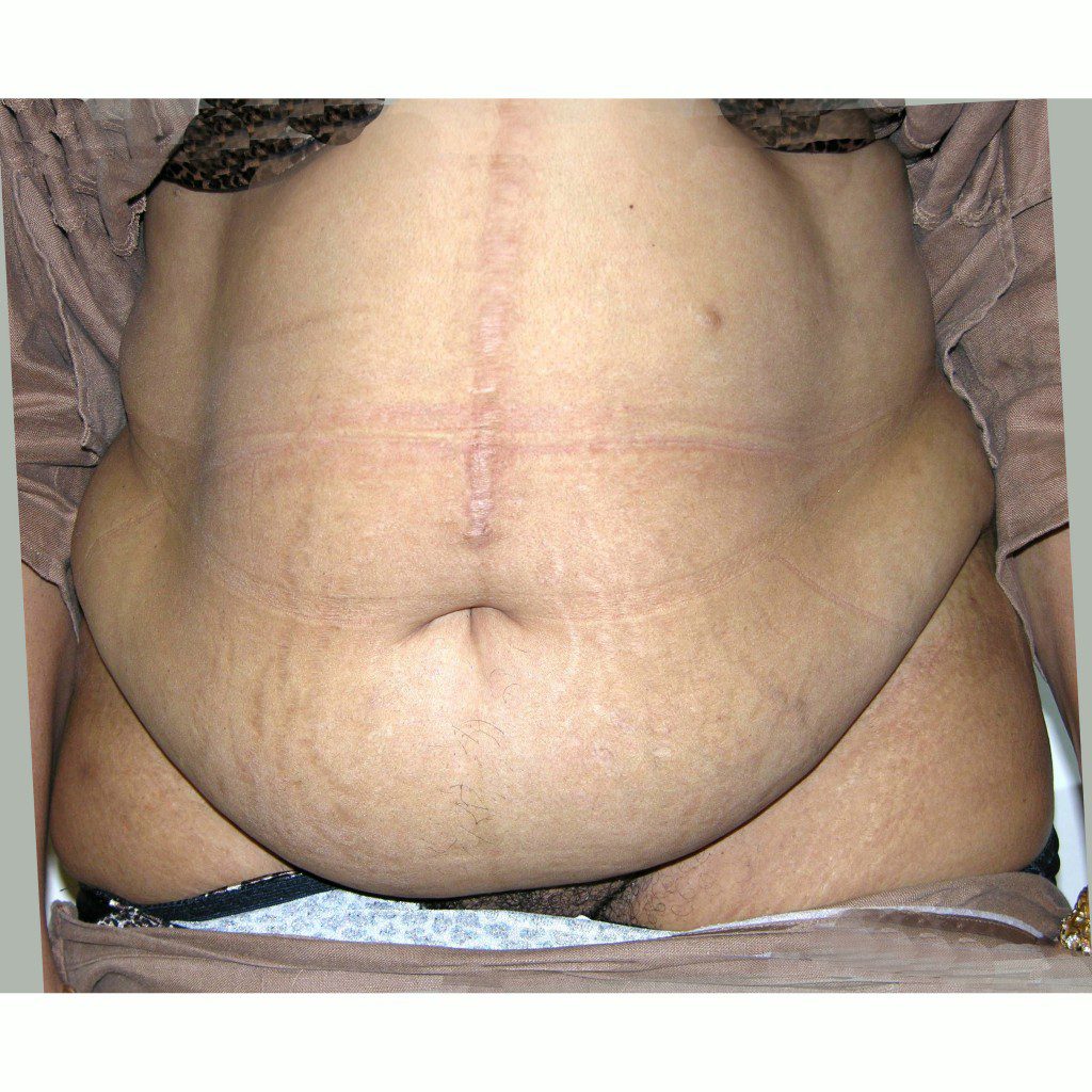 Abdominoplasty--2320 | Before Abdominoplasty 1