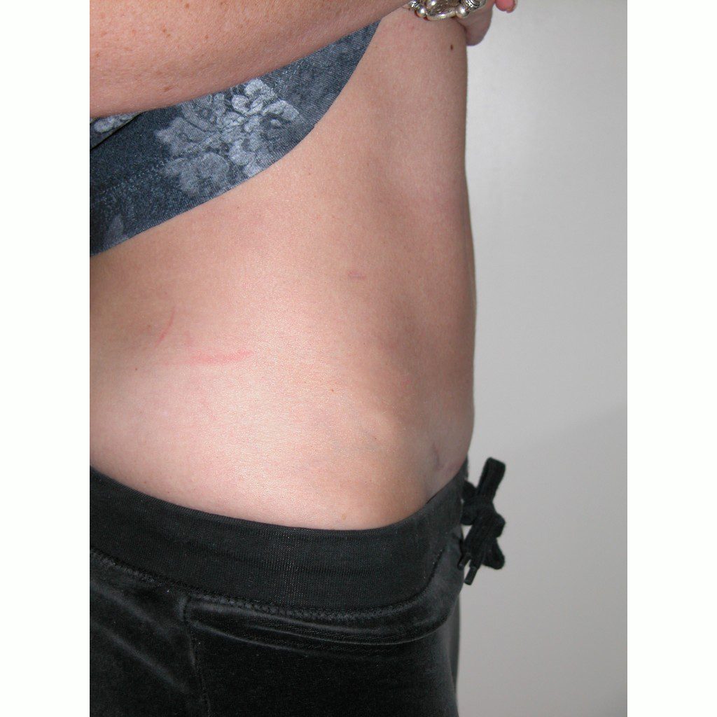 Abdominoplasty--5717 | After Abdominoplasty 2