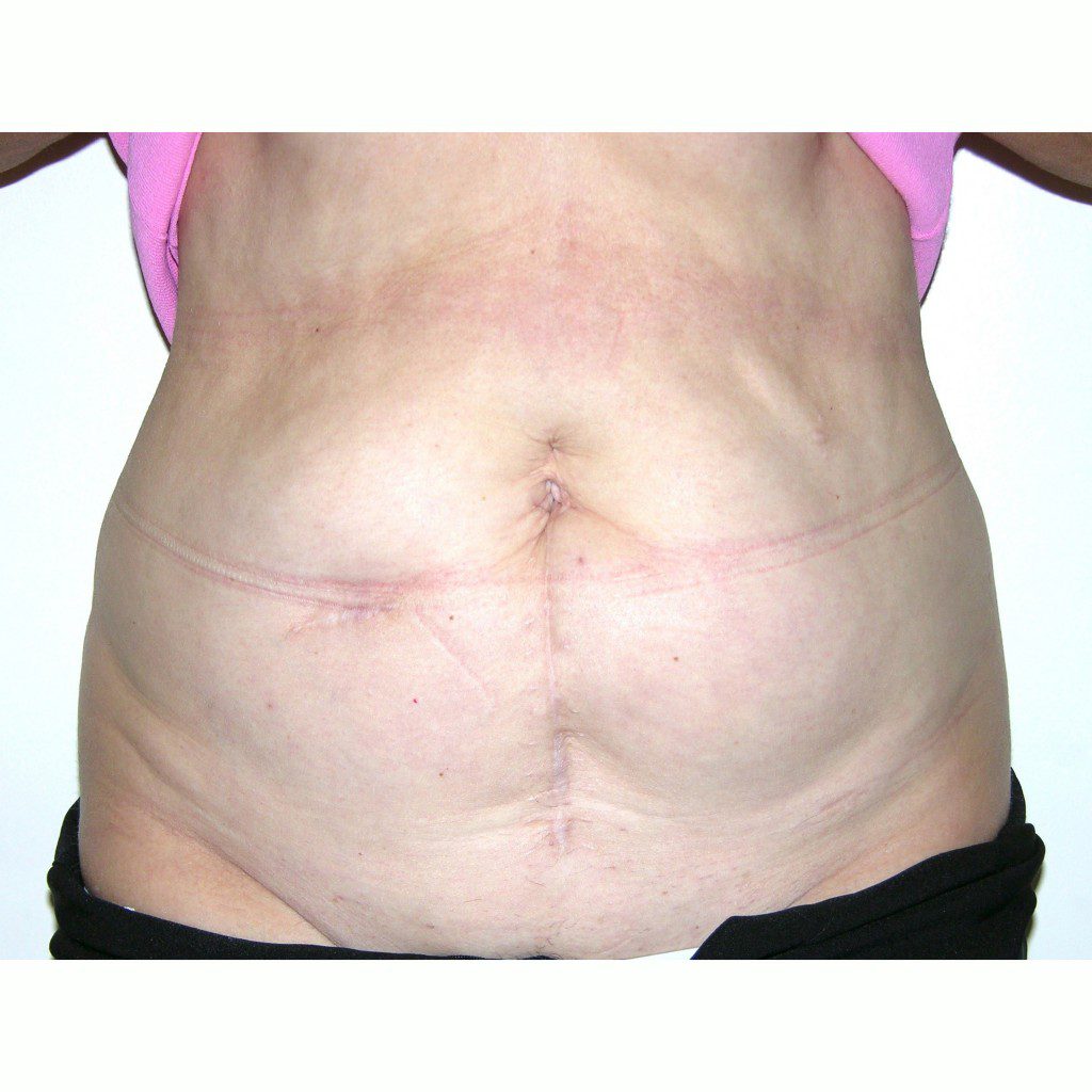 Abdominoplasty--8980 | Before Abdominoplasty