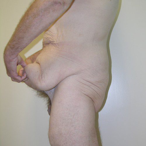 Abdominoplasty--7366 | Before Abdominoplasty 2