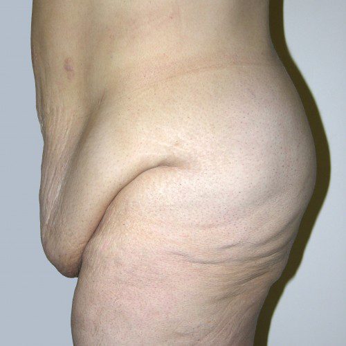 Abdominoplasty--7379 | Before Abdominoplasty 2