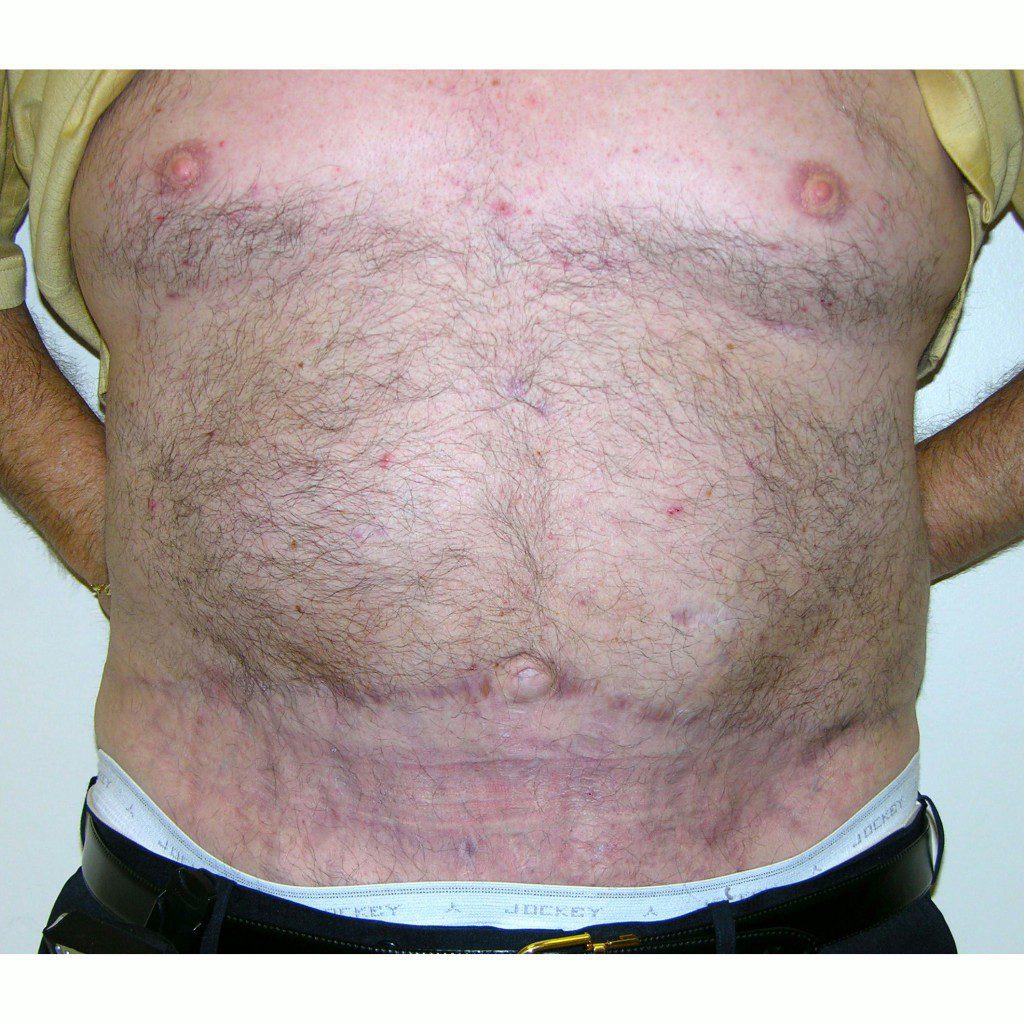 Abdominoplasty--3527 | After Body