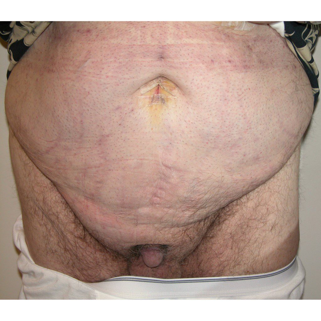 Abdominoplasty--3527 | Before Body