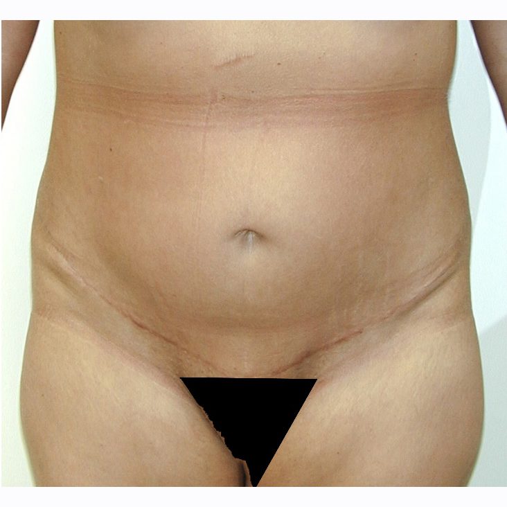 Abdominoplasty--2678 | After Body