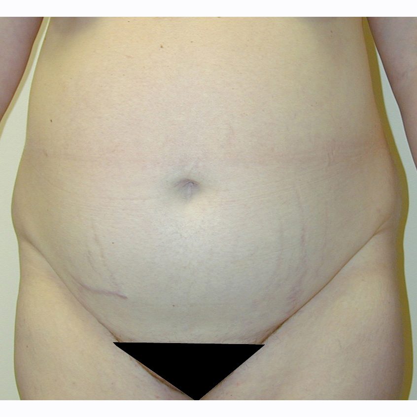 Abdominoplasty--2678 | Before Body