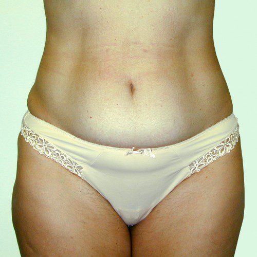 Abdominoplasty--9343 | Before Abdominoplasty