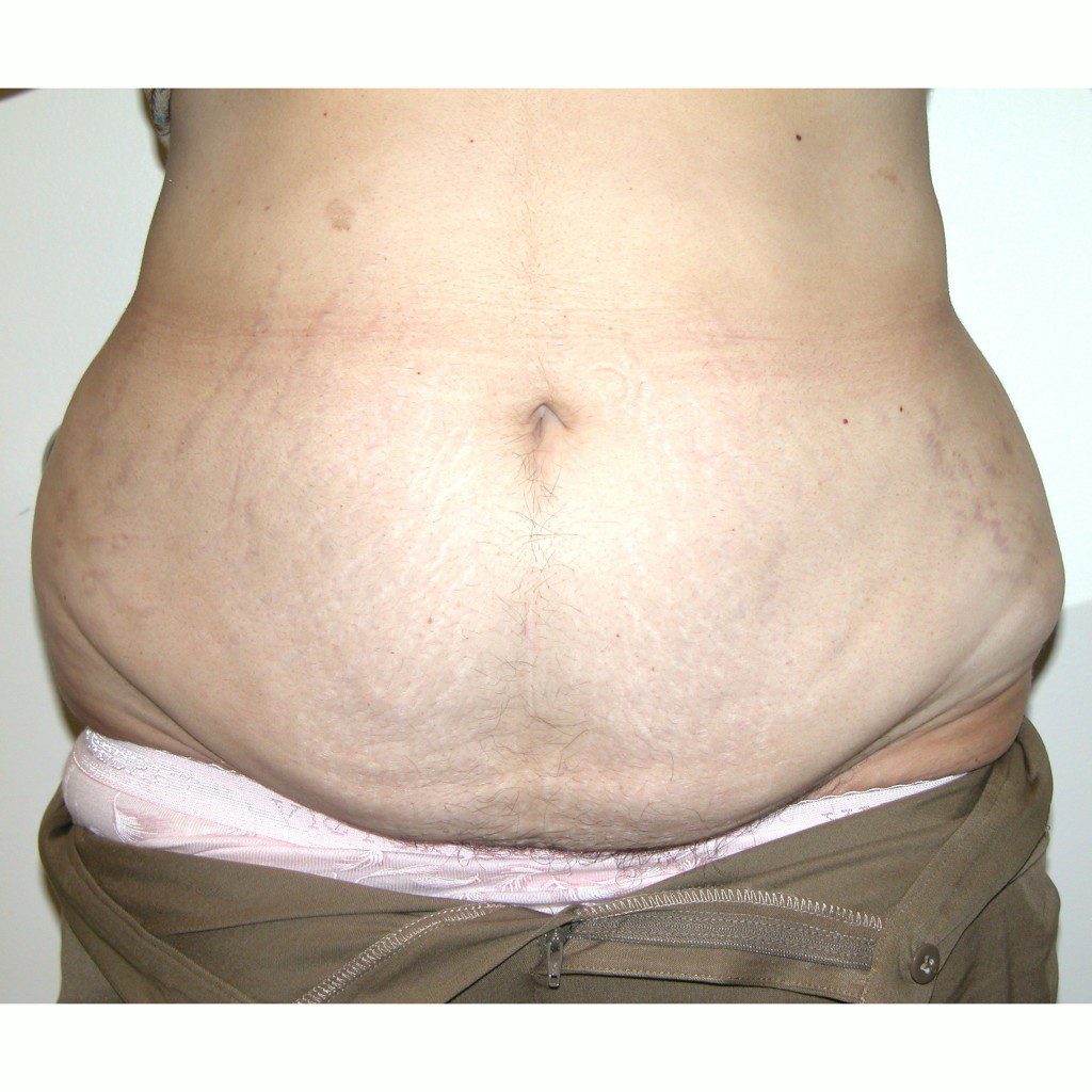 Abdominoplasty--9243 | Before Body