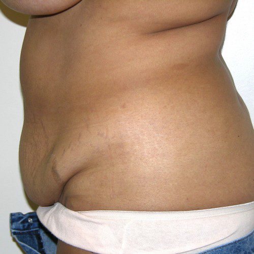 Abdominoplasty--8091 | Before Abdominoplasty 3