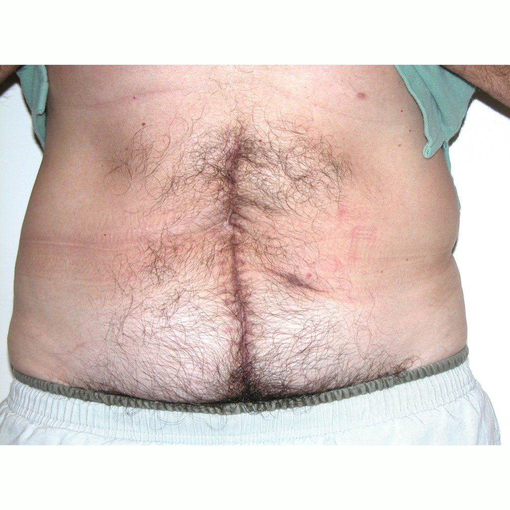 Abdominoplasty--8015 | Before Abdominoplasty 1