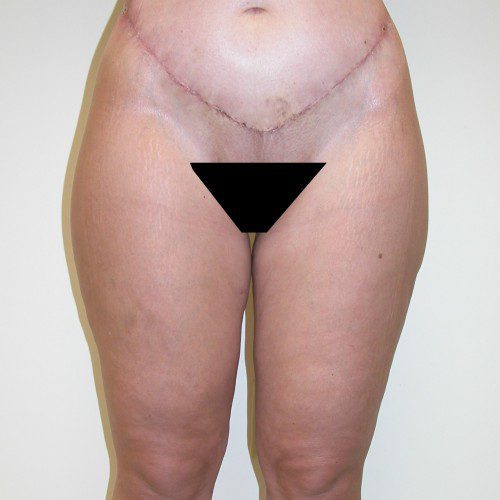 Abdominoplasty--8202 | After Body