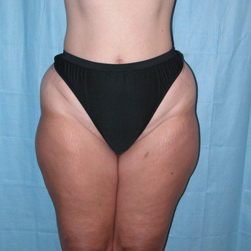 Abdominoplasty--8202 | Before Body