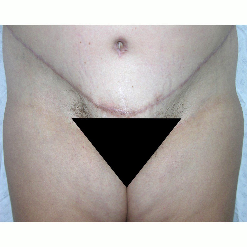 Abdominoplasty--8559 | After Body