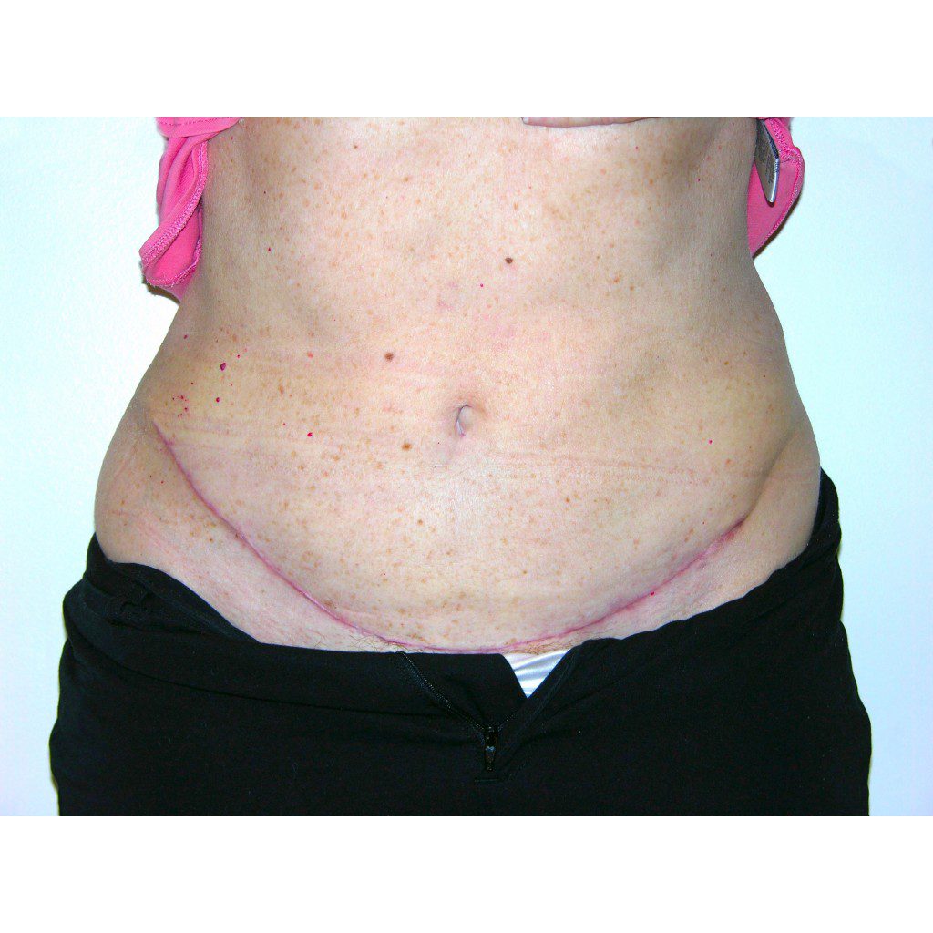 Abdominoplasty--6620 | After Body