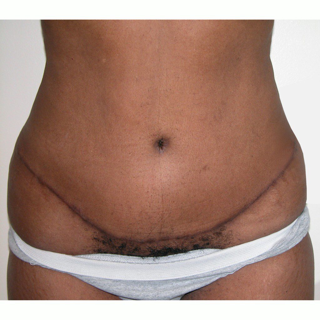 Abdominoplasty--5482 | After Abdominoplasty