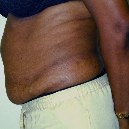 Abdominoplasty--5482 | Before Abdominoplasty 2