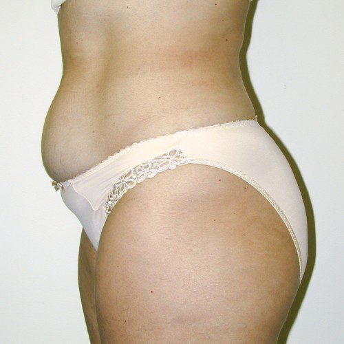 Abdominoplasty--1867 | Before Abdominoplasty 2