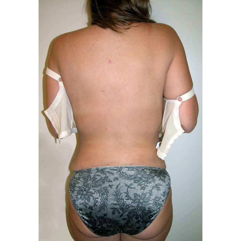 Abdominoplasty--7437 | After Abdominoplasty 3