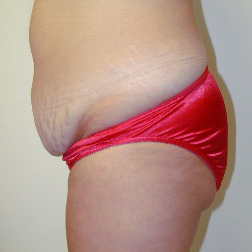 Abdominoplasty--7437 | Before Abdominoplasty 2