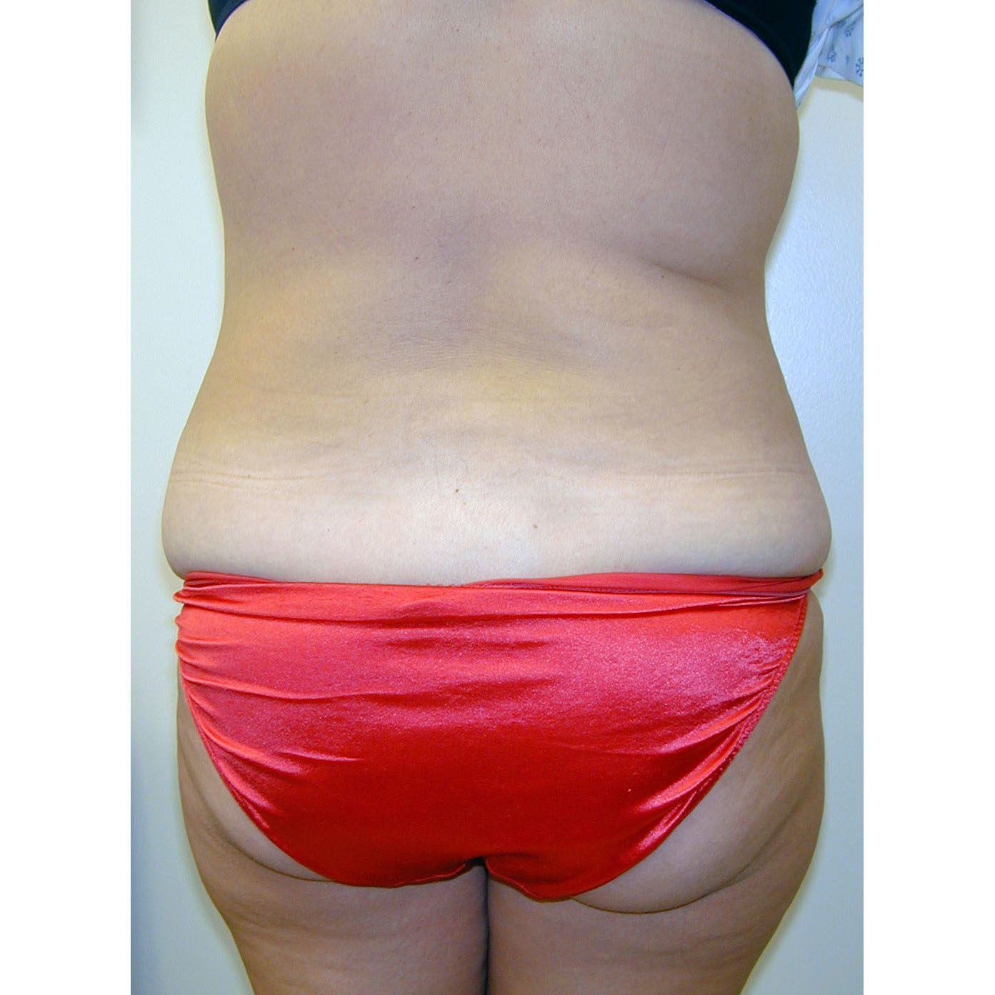Abdominoplasty--7437 | Before Abdominoplasty 3