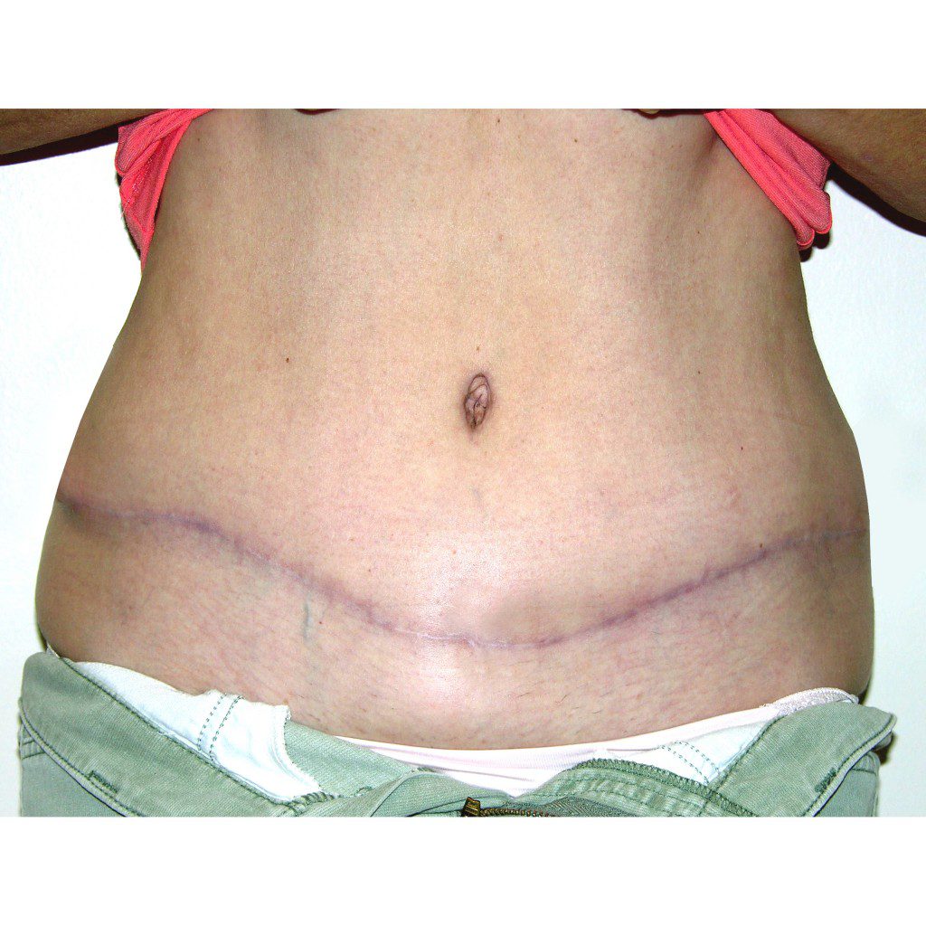 Abdominoplasty--8980 | After Abdominoplasty