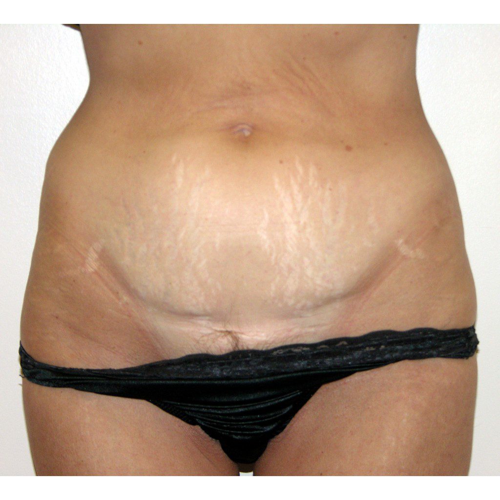 Abdominoplasty--9946 | Before Abdominoplasty 3