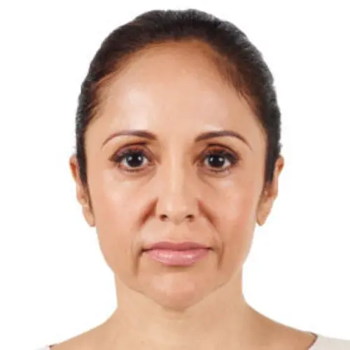 Case--9625 | Before Injectable Fillers 1