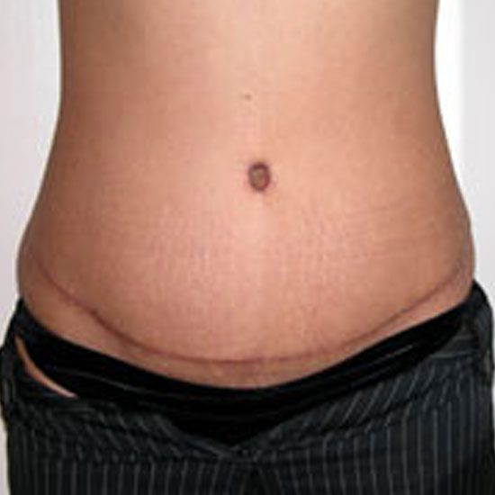 Abdominoplasty--6200 | After Body
