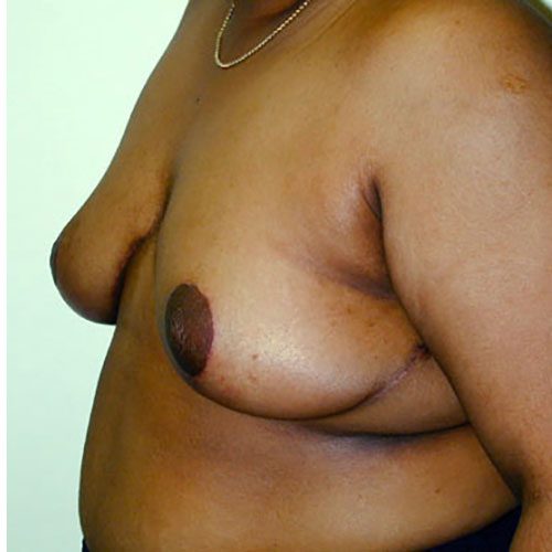 Breast-Reduction--3251 | After Breast Reduction 2
