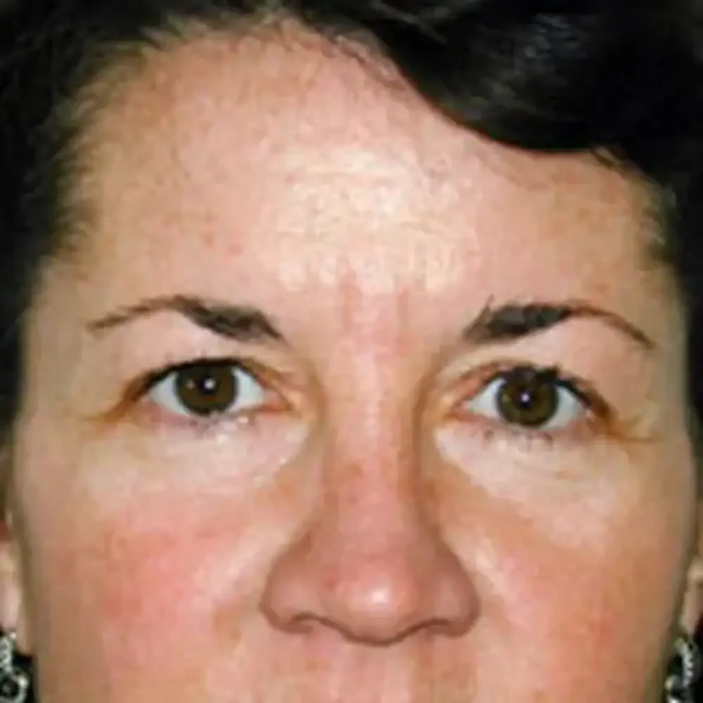 Brow-Lift--8574 | Before Brow Lift
