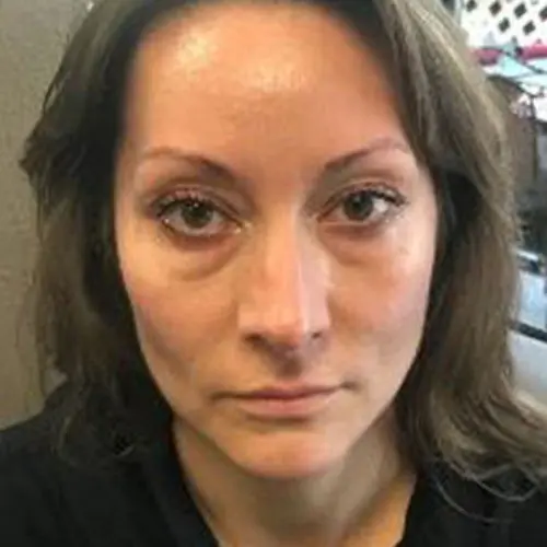 Case--2828 | Before BOTOX / Injectable Fillers 1