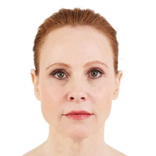 Case--2890 | After Injectable Fillers 1