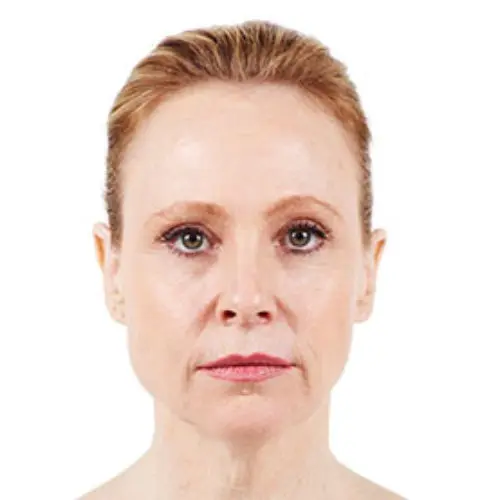 Case--2890 | Before Injectable Fillers 1