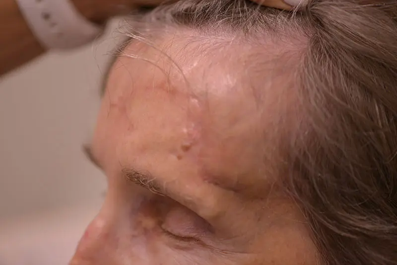 Mohs-Surgery--8827 | After Mohs Surgery