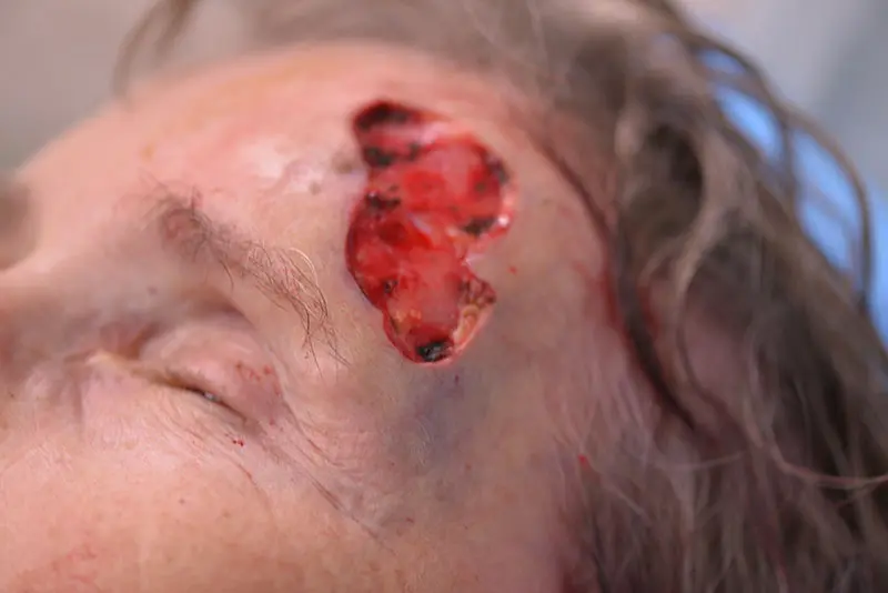Mohs-Surgery--8827 | Before Mohs Surgery