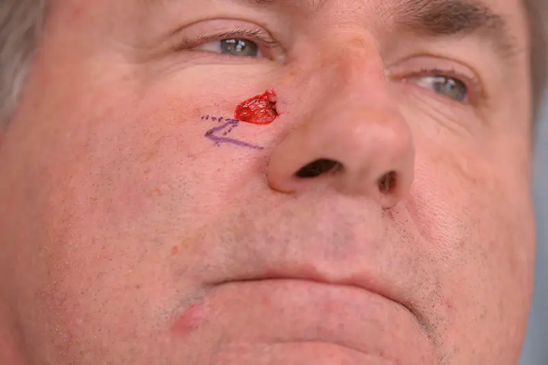 Mohs-Surgery--3722 | Before Mohs Surgery 1