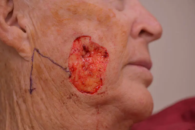 Mohs-Surgery--4383 | Before Mohs Surgery
