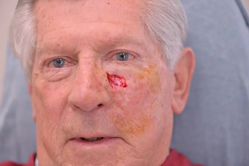Mohs-Surgery--9628 | Before Mohs Surgery 1