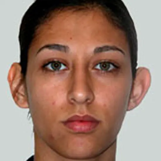 Otoplasty--5119 | Before Face